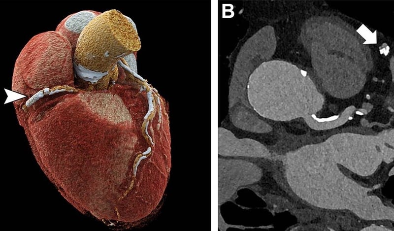 New High-Tech CT Might Expand Heart Imaging