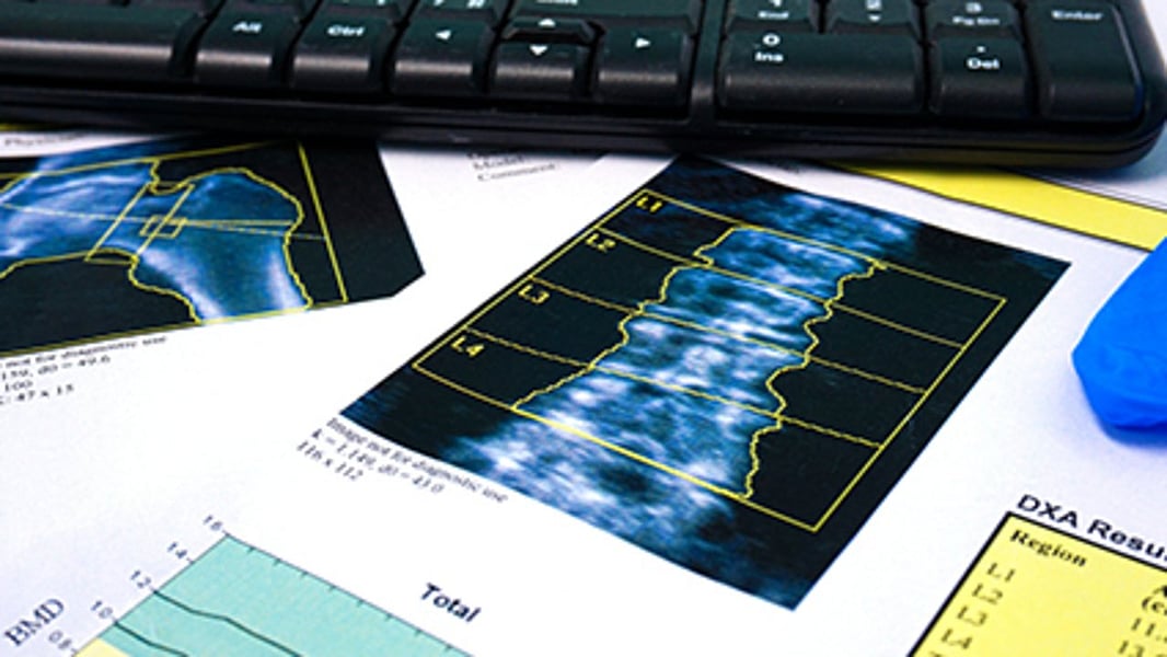 Popular Weight-loss Surgery May Weaken Bones in Young Patients - Consumer Health News - Vimarsana News