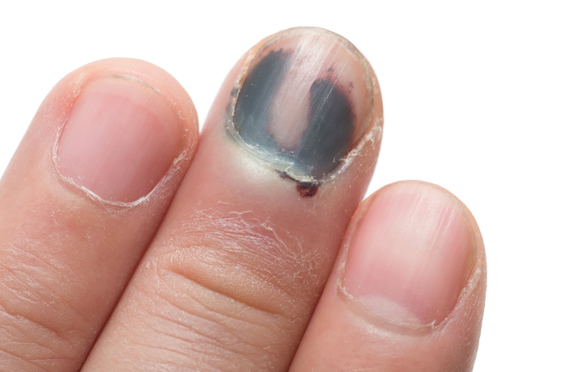 News Picture: Ouch! You Injured a Nail: Tips on Best Treatment