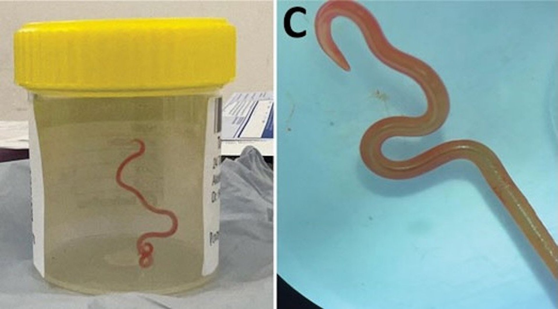 News Picture: Doctors Pulled Live Worm From Australian Woman's Brain