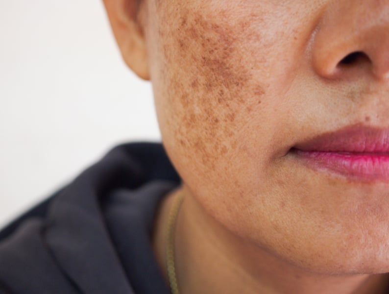 Melasma: New Dark Patches or Freckling -- A Dermatologist Offers Tips on Dealing With It