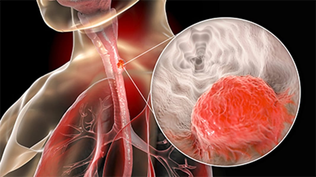 Most People With Acid Reflux Do Not Face Higher Cancer Risk - Consumer Health News - Vimarsana News